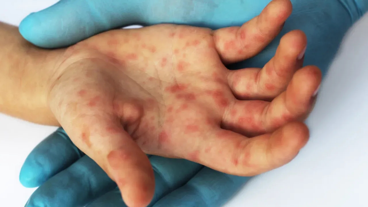 Casos de sarampo são confirmados no Rio de Janeiro