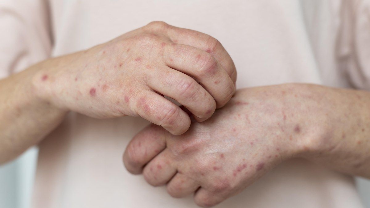 São Paulo confirma primeiro caso de sarampo em 2025