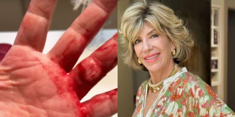 Silvia Poppovic fica ensanguentada ao ser vítima de assalto perto de sua casa