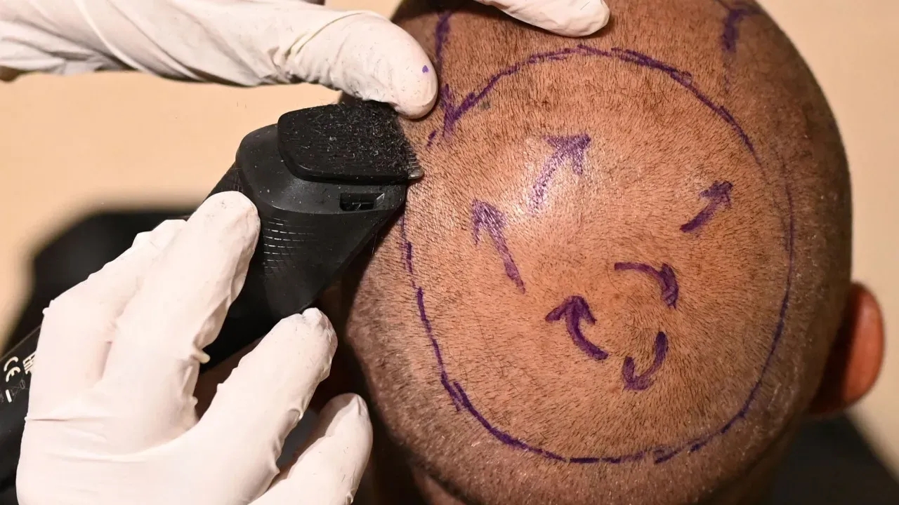 Policial falece após transplante capilar; entenda os riscos