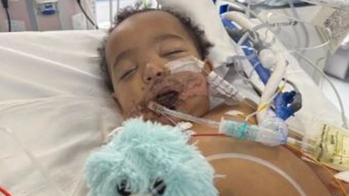 Bebê perde língua após engolir soda cáustica acidentalmente