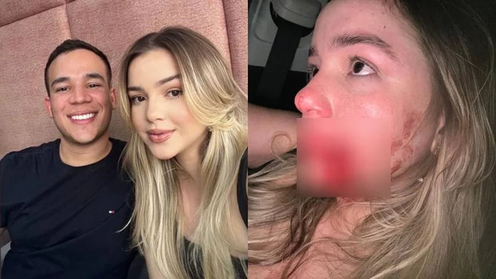 Modelo leva soco de síndico e fica com buraco no rosto