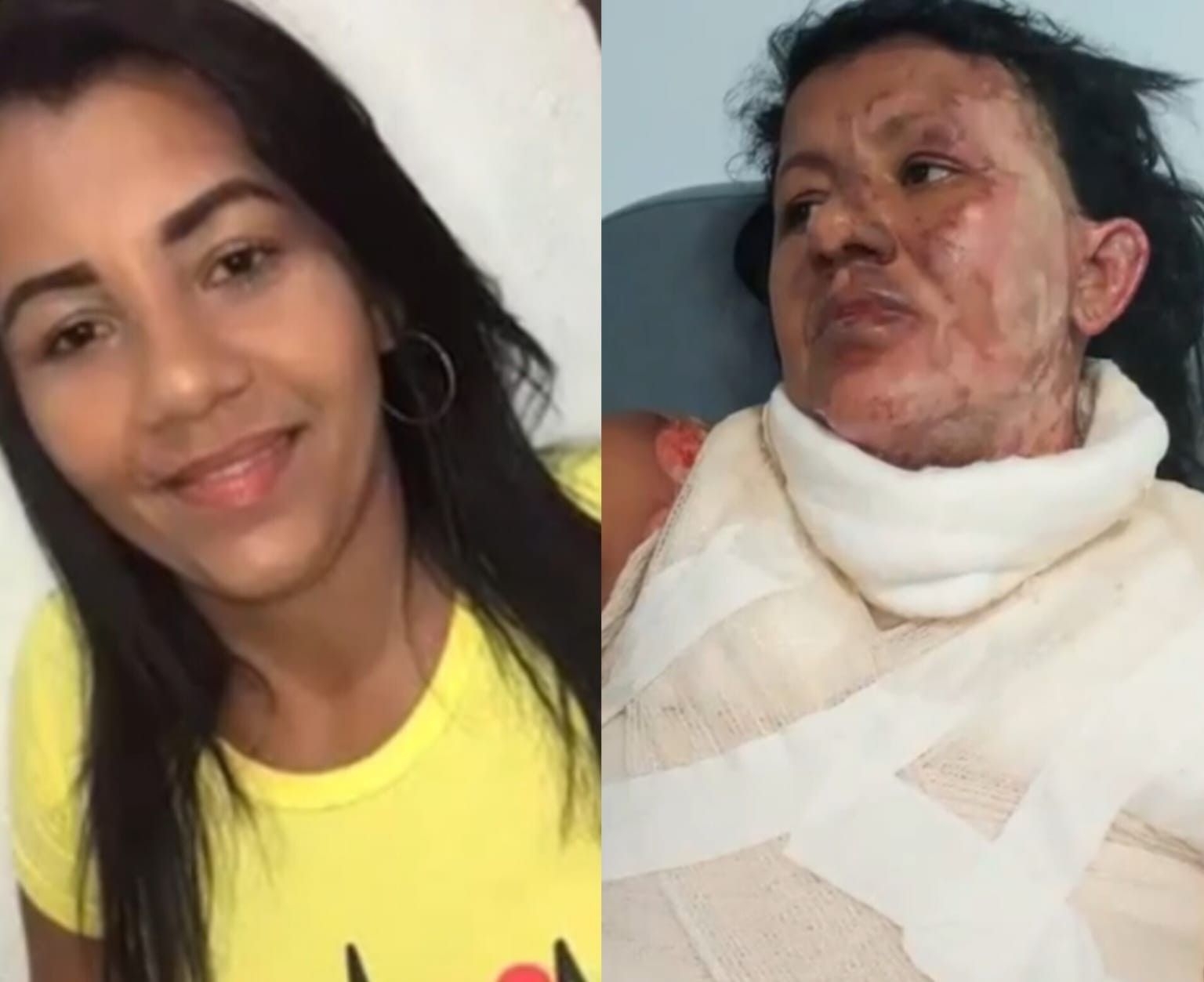 Homem é preso por atear fogo na esposa em Maceió