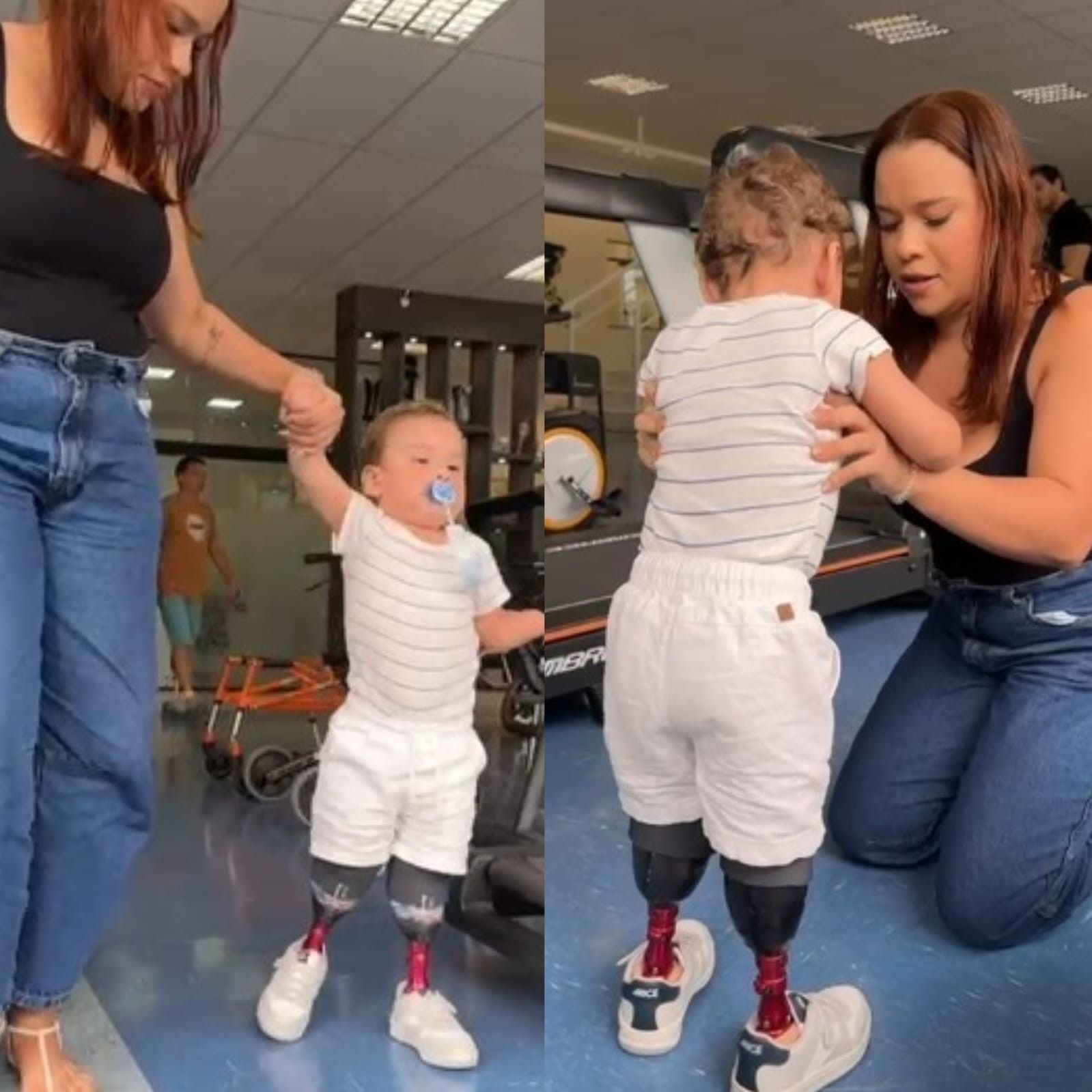 Criança amputada ganha próteses após desvio de doações