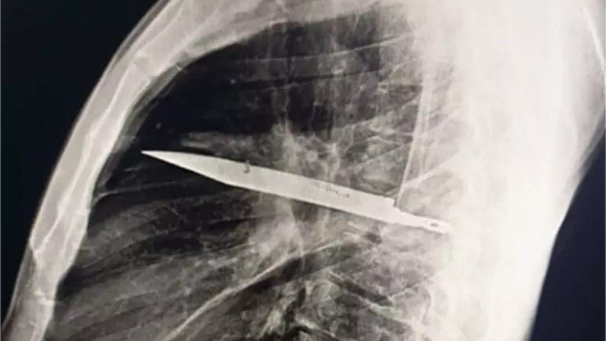 Homem descobre faca alojada no peito após oito anos