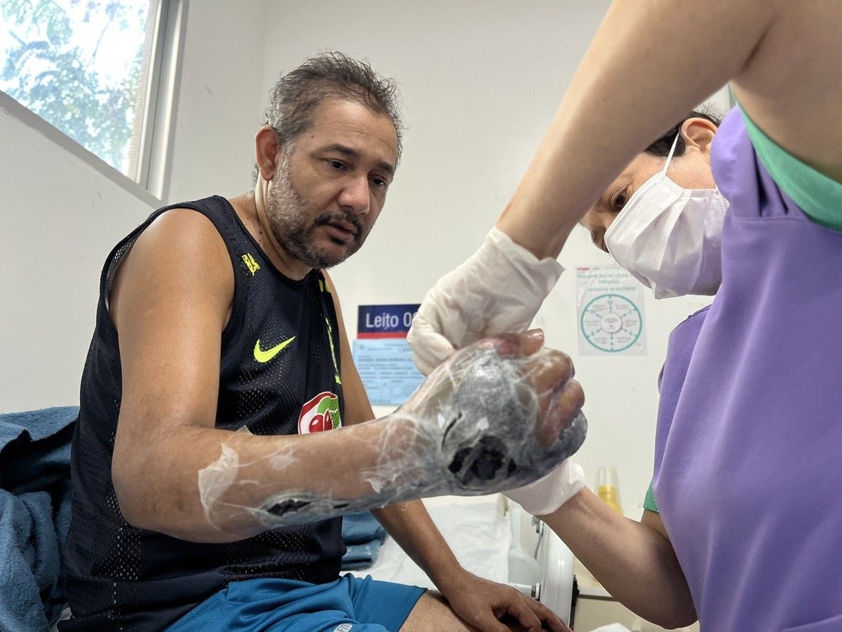 Pedreiro celebra alta após 40 dias internado por picada de aranha-marrom