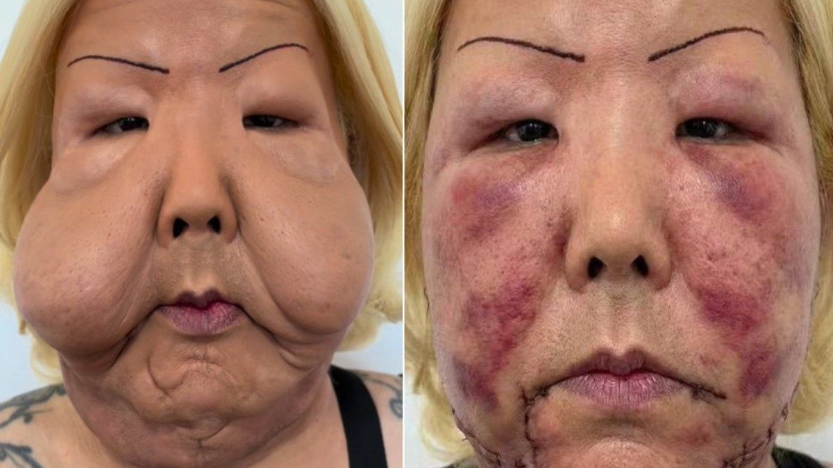 Influenciadora Juju do Pix passa por cirurgia reparadora