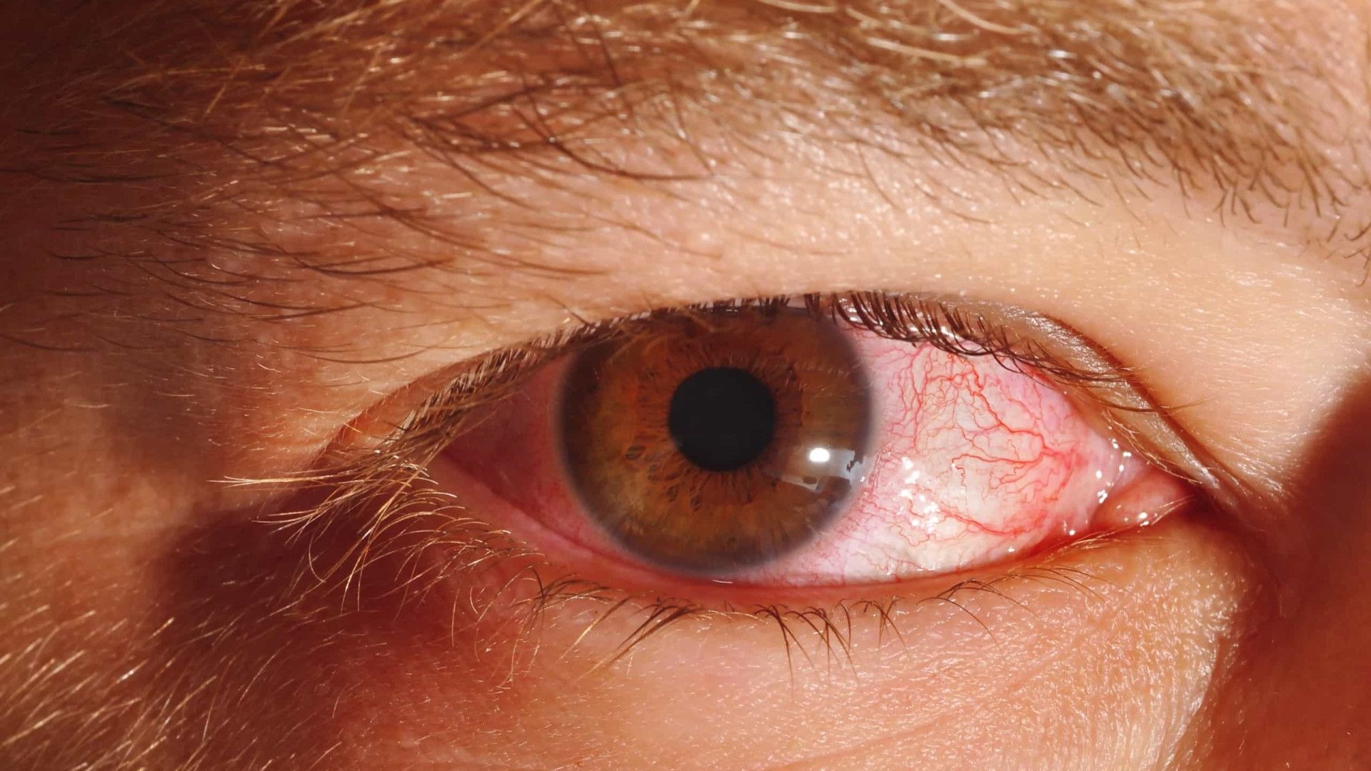 Pacientes lotam emergência do Rio após uso de pomada modeladora de cabelo no Natal