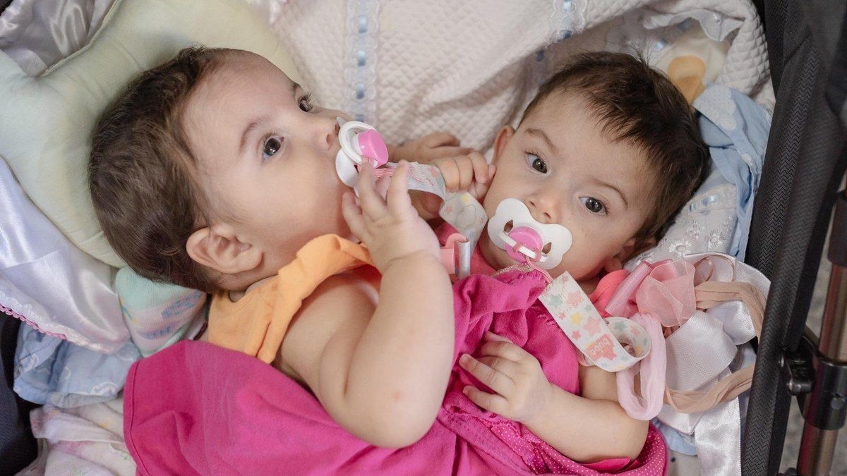 Gêmeas siamesas no Goiás passam por cirurgia de separação