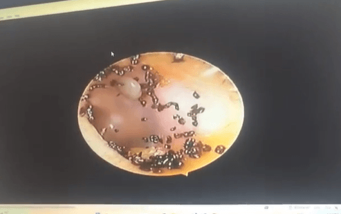 Menina descobre mais de 100 carrapatos no ouvido