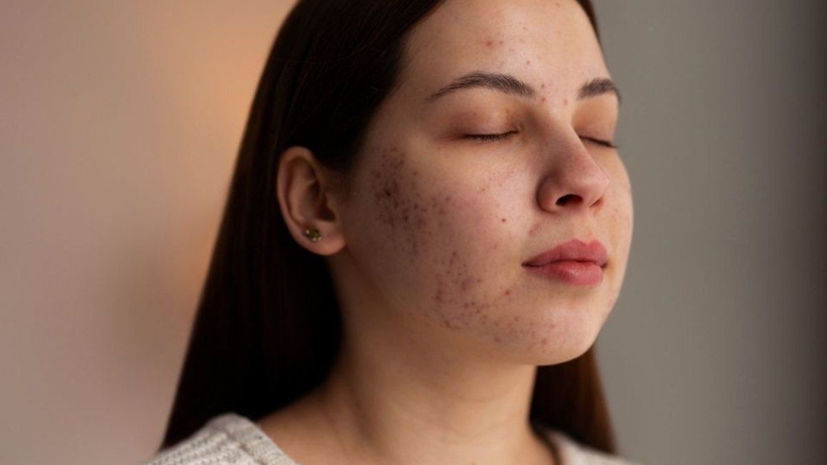 Estratégias eficazes de Mariana Correa contra o melasma
