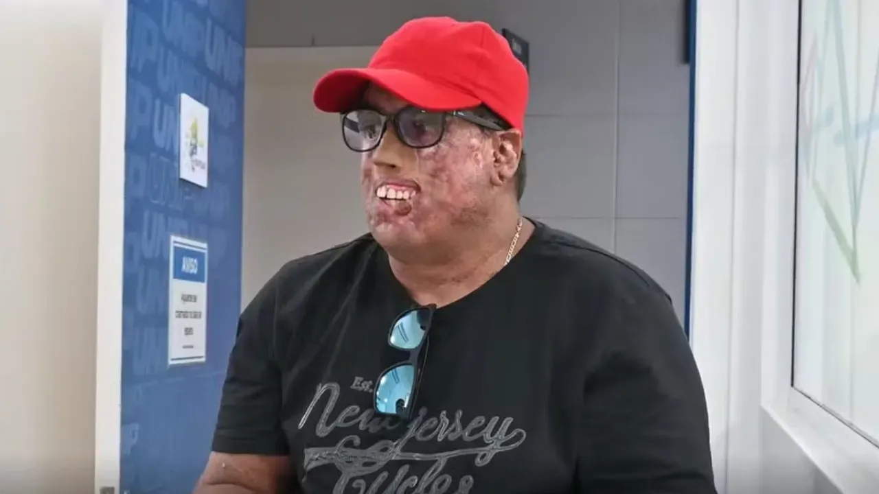 Homem supera doença rara com 230 cirurgias e prótese