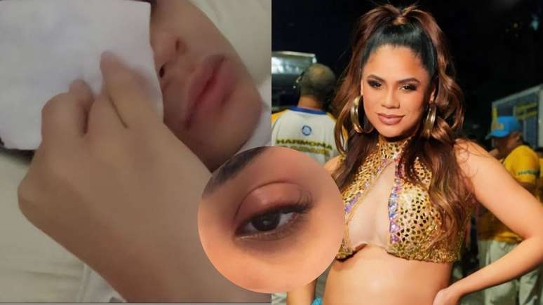 Com inchaço no olho, Lexa cancela compromissos e desabafa: 'Já já estarei 100%'