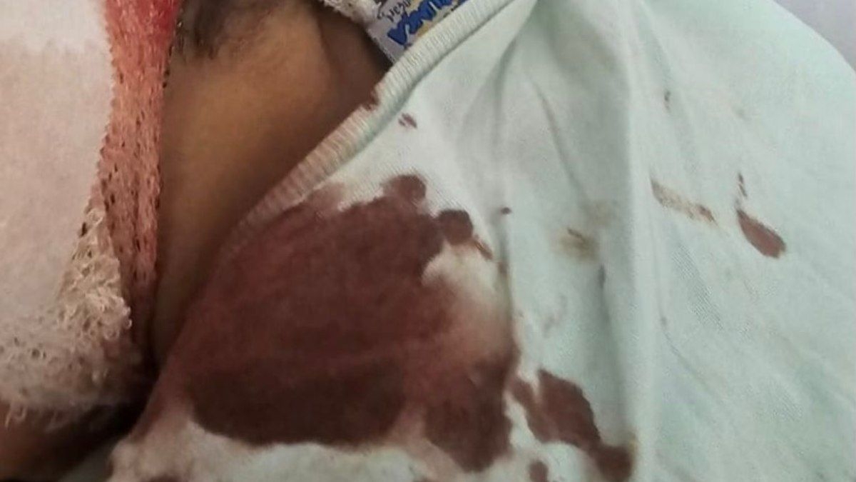 Criança sofre ataque de cão e fica gravemente ferida