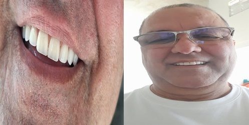 Relato de experiência cirúrgica de sucesso com os doutores Igor Lerner e Bruno Marinho