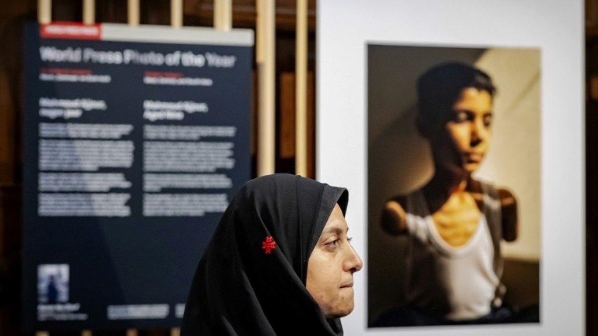 Menino palestino amputado é destaque no World Press Photo