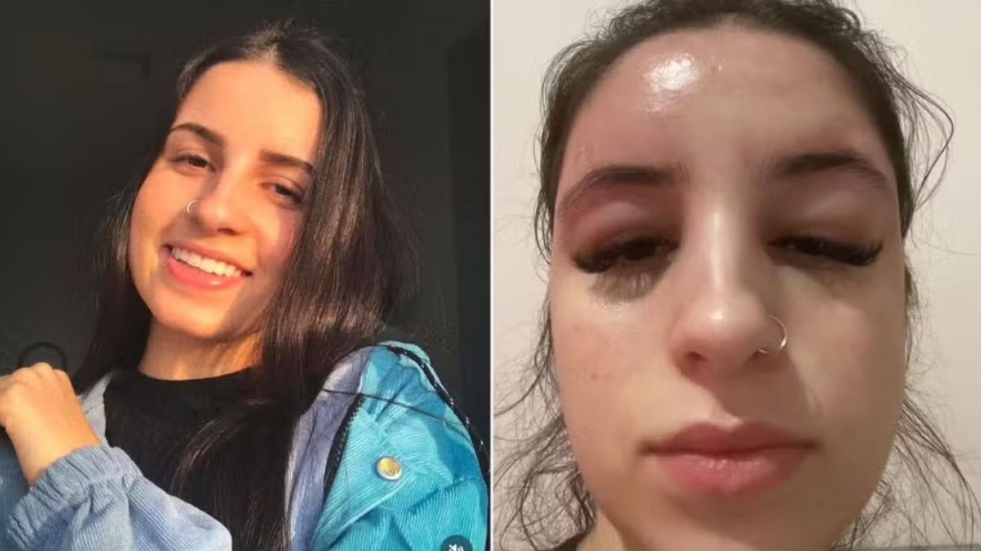 'Espremi duas espinhas e tive uma infecção das bactérias das unhas'